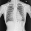 Medical X-Ray Film