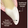 Fixed Restoration Lumineers Veneers