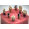 Fixed Restoration Customized Abutment