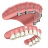 Removable Prosthetic Implant Overdentures