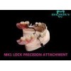 MK1 Custom Precision Attachment Dentures Excellent Retention Co-Cr Material